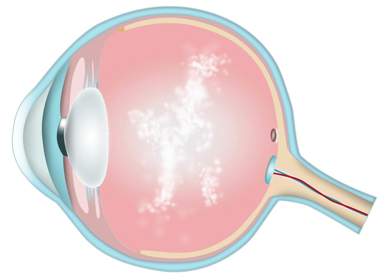 Flydere (floaters) kan give skyformede uklarheder.