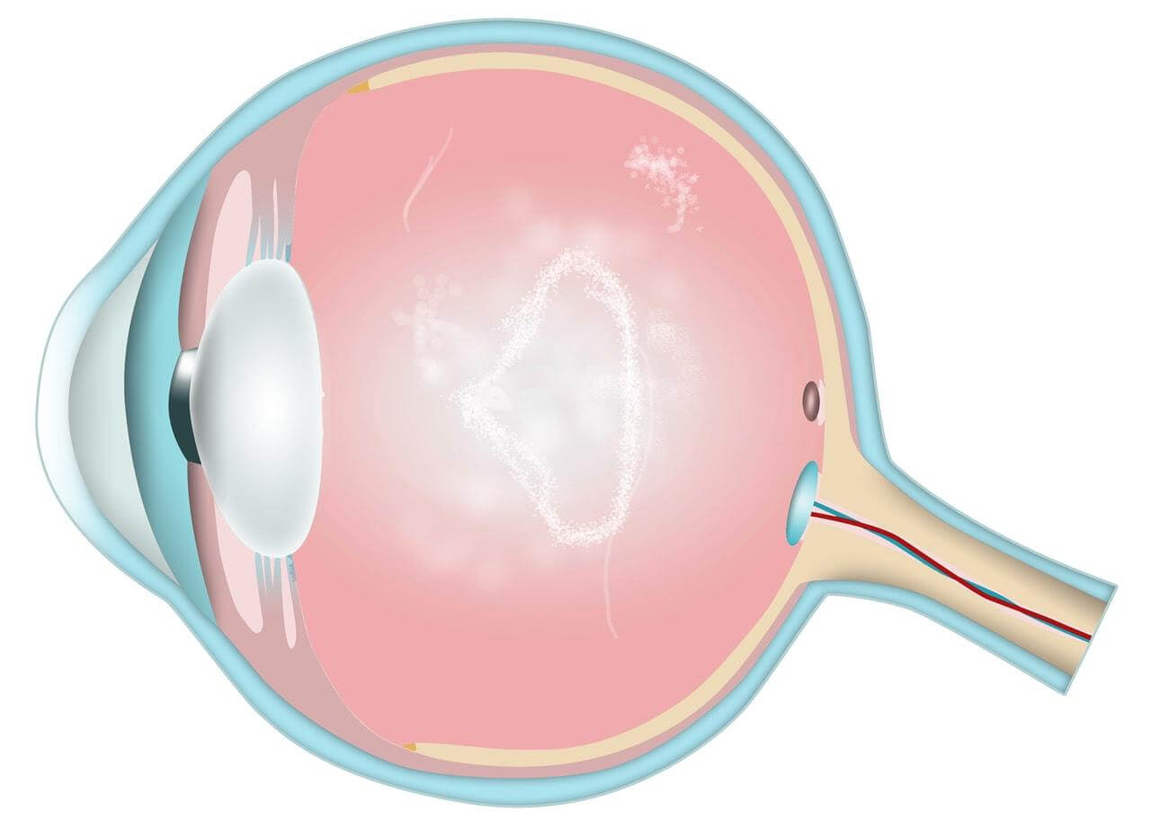 Flydere (floaters) kan give ring-formede uklarheder.