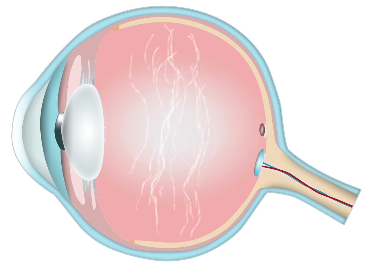 Flydere (floaters) kan give spindelvæv-lignende uklarheder.