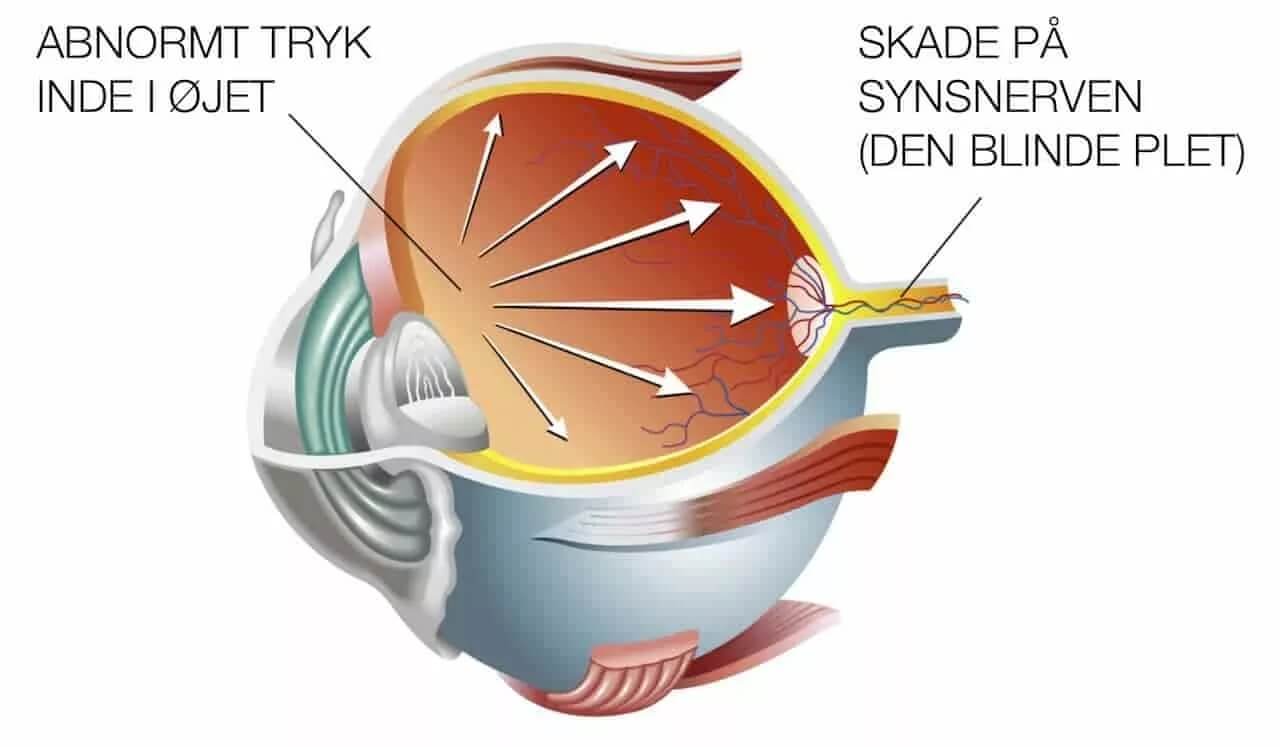 Et tværsnit af øjet i tilfælde af Grøn Stær
