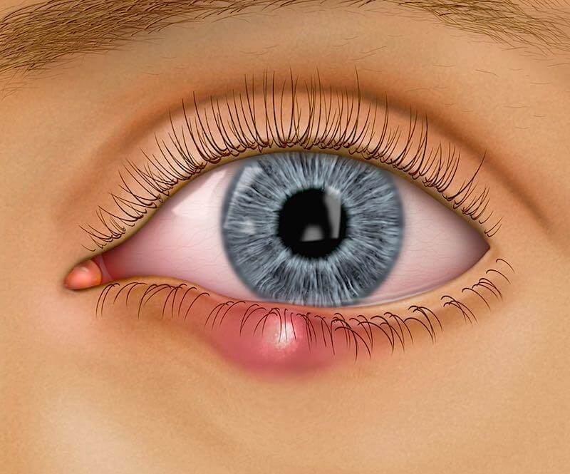 Et bygkorn på underside af øjenlåg.