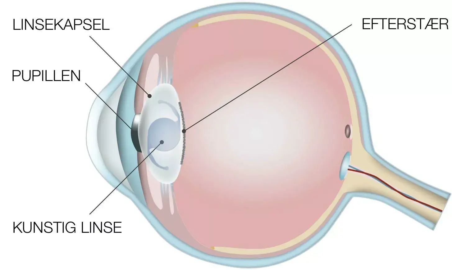 Illustration af efterstærs placering i øjet.