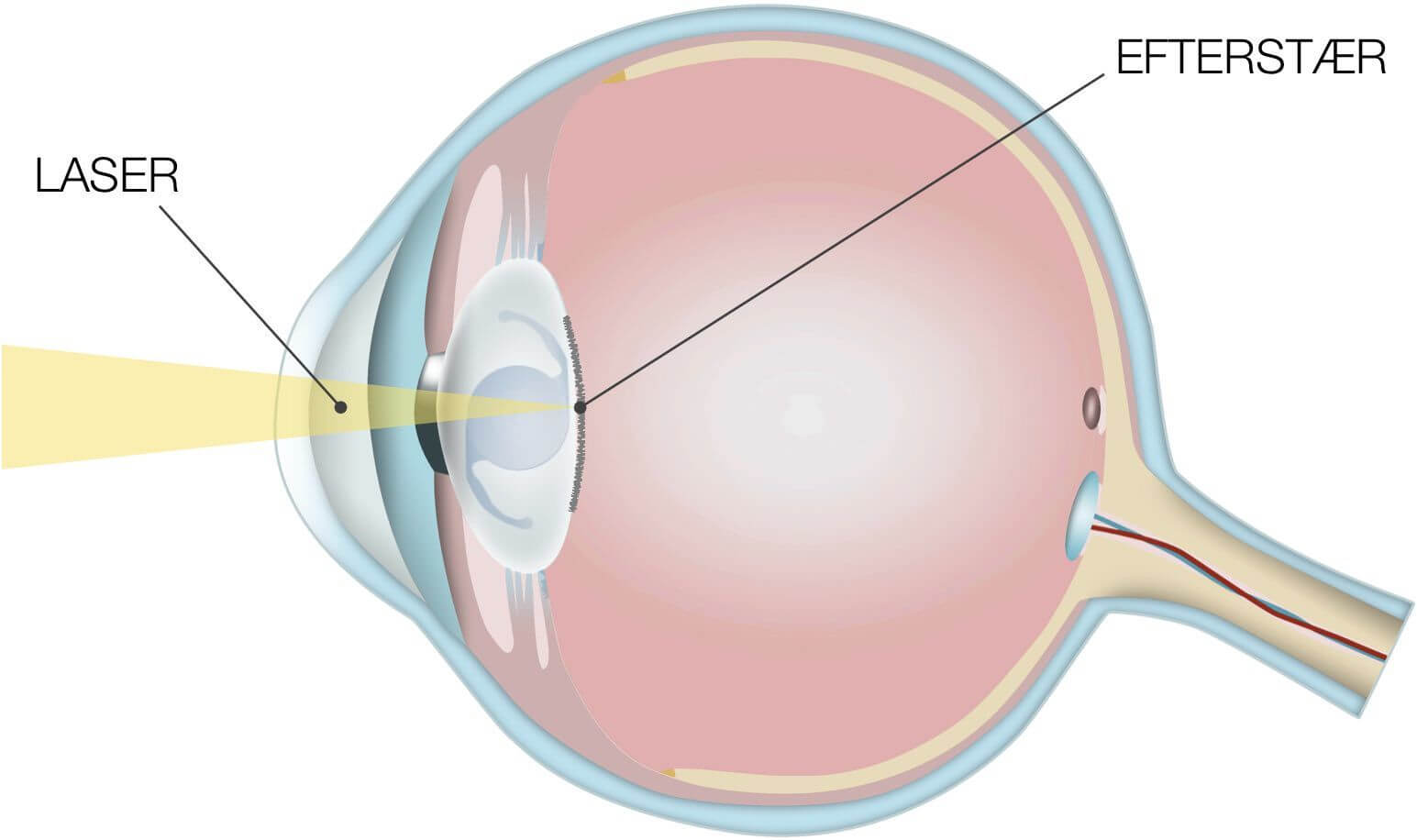 Simpel illustration af en efterstærs behandling ved laser.
