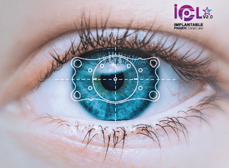 permanent kontaktlinse ICL eller IPCL