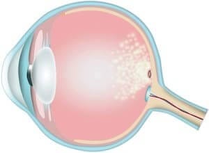 amd drusen druser behandling