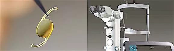 Tør AMD behandling med laser og linser