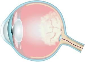 amd tør behandling operation