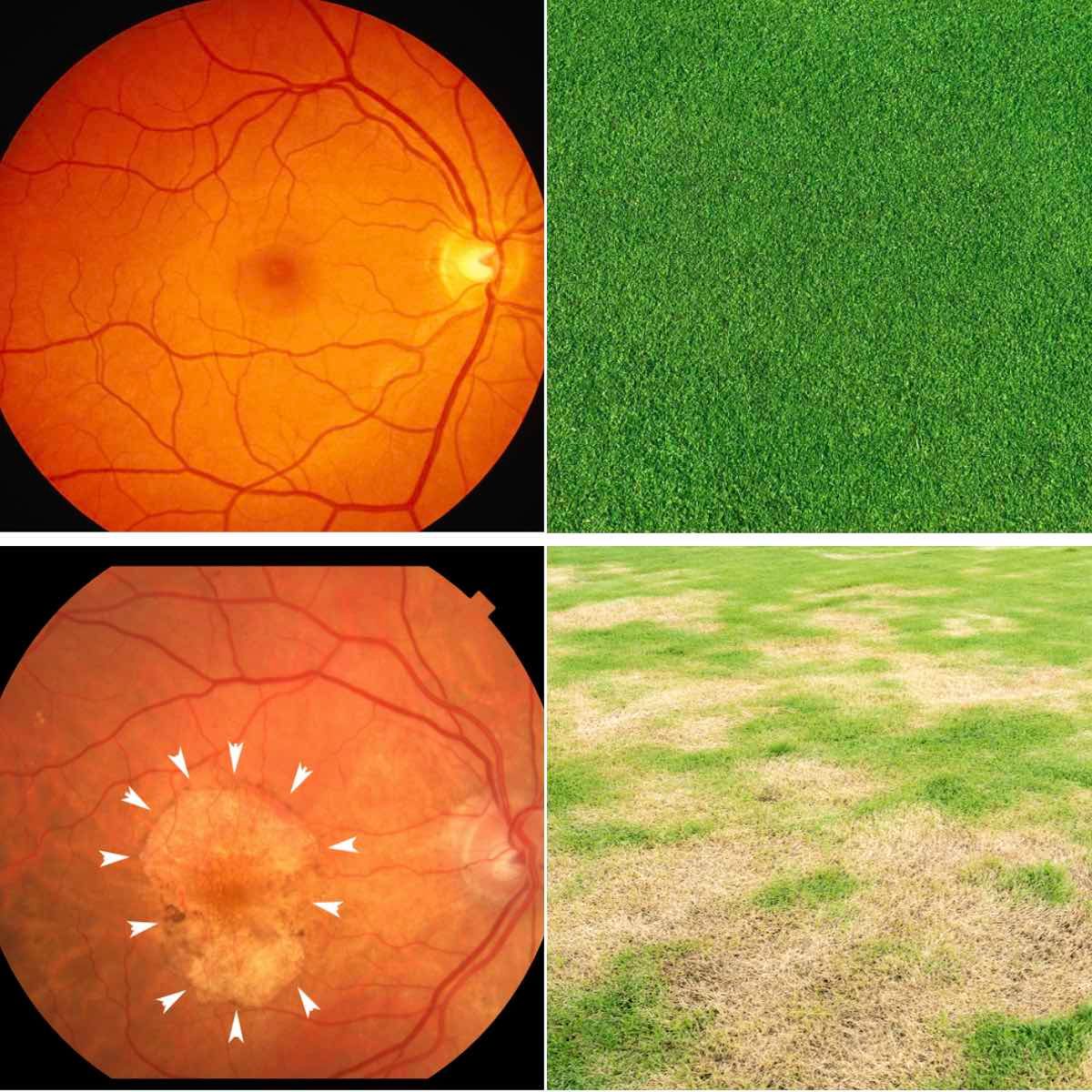 Tør AMD, nethindens udvikling og degeneration.